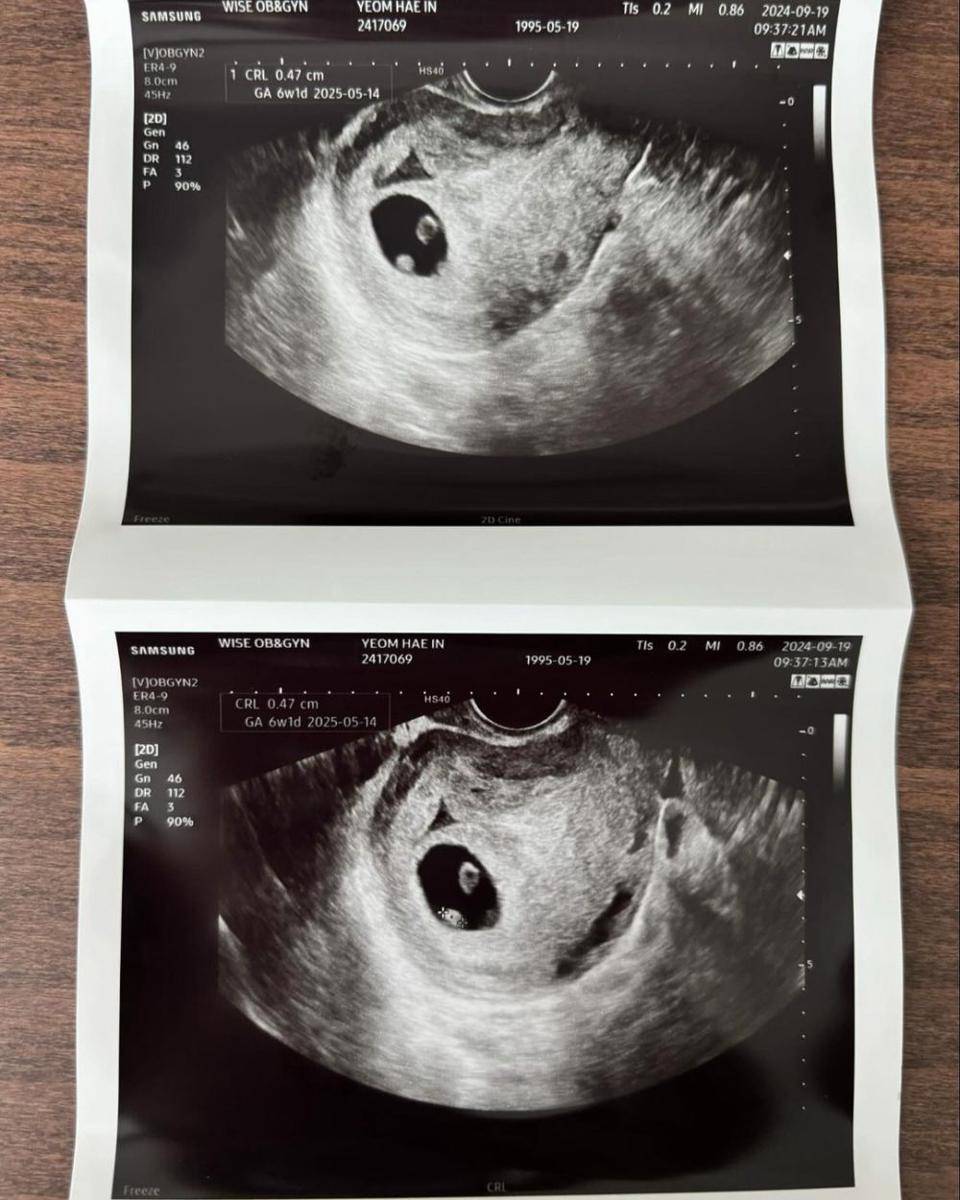 hasil USG anak ke-2 Haein (instagram.com/hhae_in)