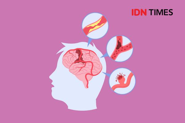 Perbedaan Stroke Iskemik dan Hemoragik, Mana yang Lebih Bahaya?