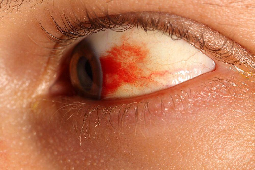 7 Penyebab Bercak Merah pada Mata, Apakah Normal?