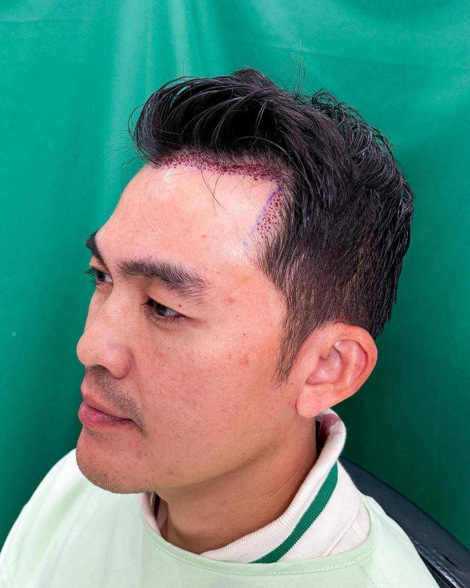 suami Tya Ariestya tanam rambut (Instagram.com/tya_ariestya)