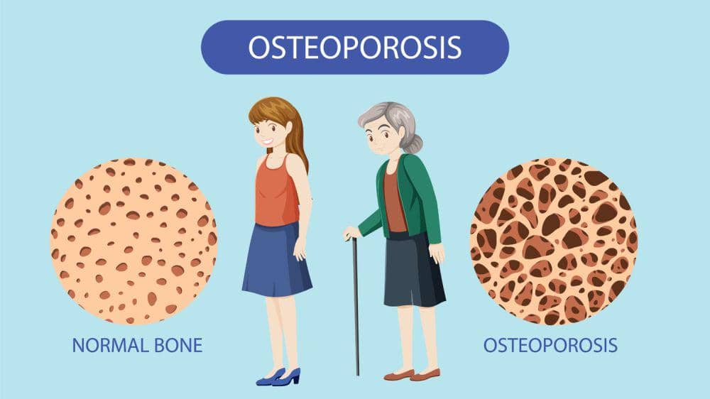 Ilustrasi perbandingan struktur tulang normal yang padat dengan tulang osteoporosis yang lebih keropos dan berpori.