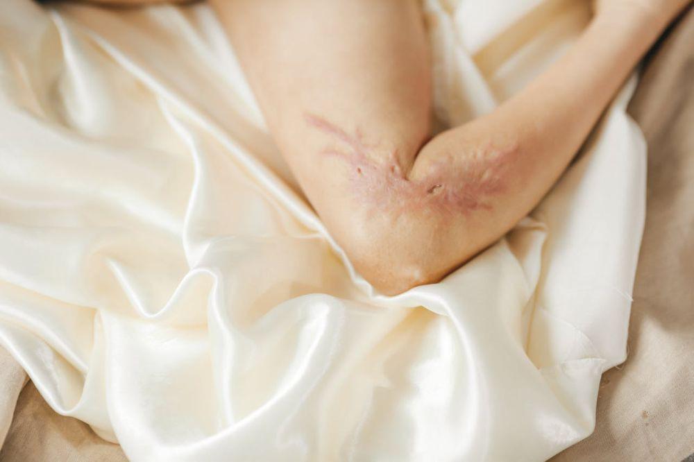 Kenali Perbedaan Piercing Bump dan Keloid