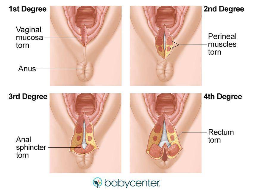 gambar tingkatan robekan miss v setelah melahirkan normal (babycenter.com)