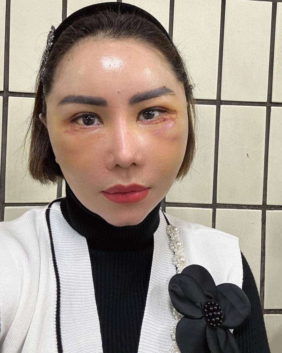 potret Femmy Permatasari operasi plastik di Korea (instagram.com/femmypermatasari)