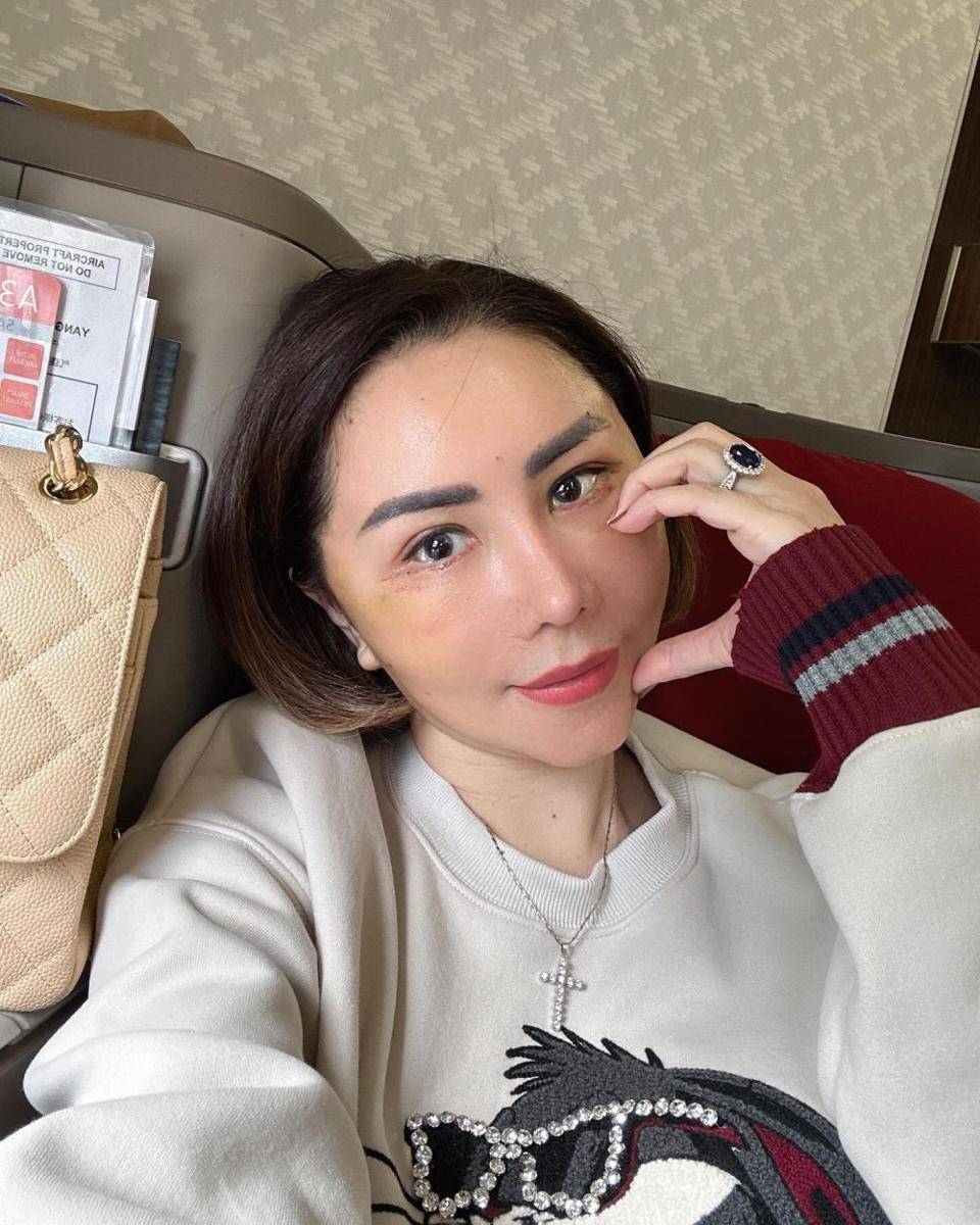 potret Femmy Permatasari operasi plastik di Korea (instagram.com/femmypermatasari)