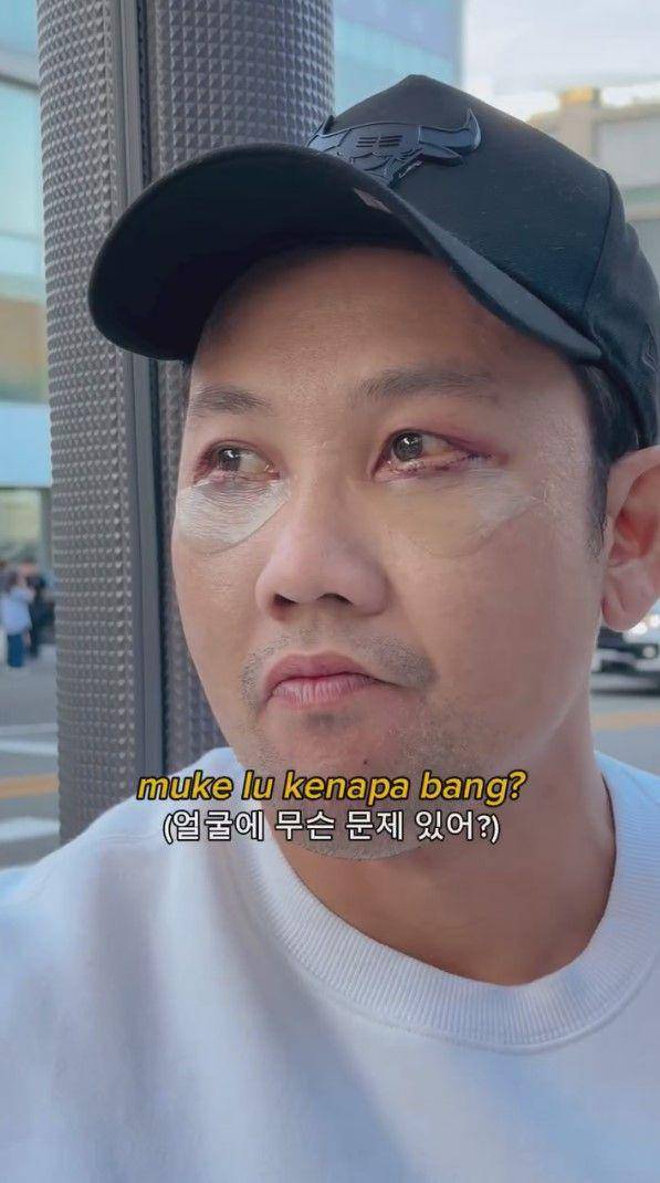 potret Denny Sumargo oplas di Korea (instagram.com/sumargodenny)