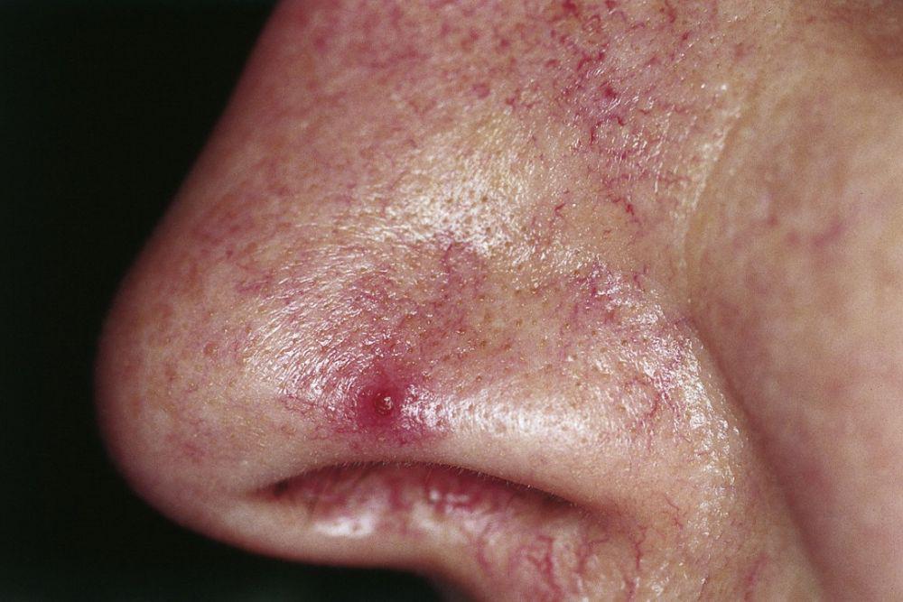 Spider Angioma: Penyebab, Gejala, Pengobatan