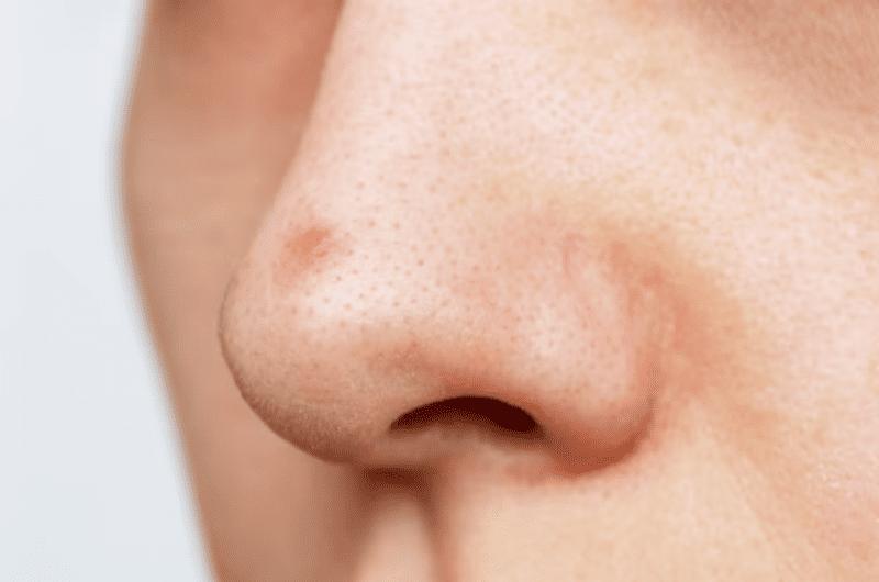ilustrasi jerawat di hidung (cureskin.com)