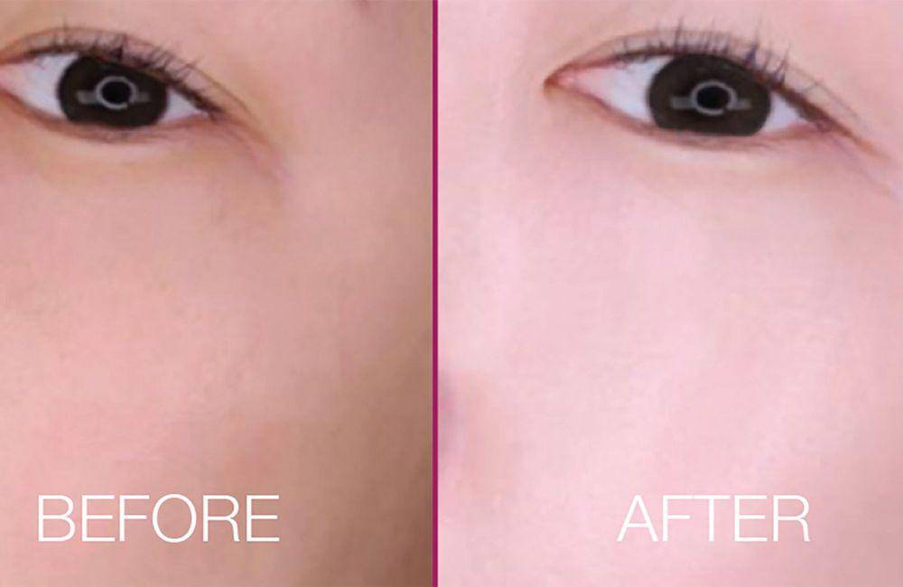 Potret wajah ketika sebelum (before) dan sesudah (after) memakai produk MSGLOW Beauty White BB Premium. (dok. MSGLOW Beauty)