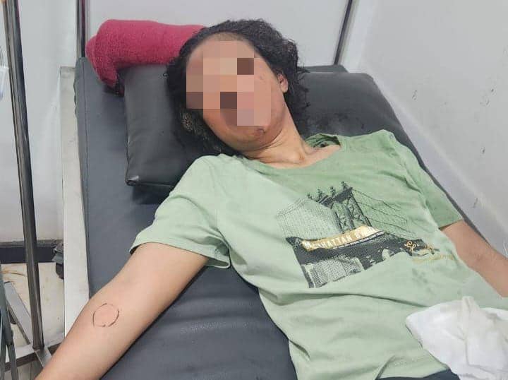 LW, pelaku pembakaran terhadap suaminya juga mengalami luka bakar 6 persen. (Dok. Polsek Muara Jawa)