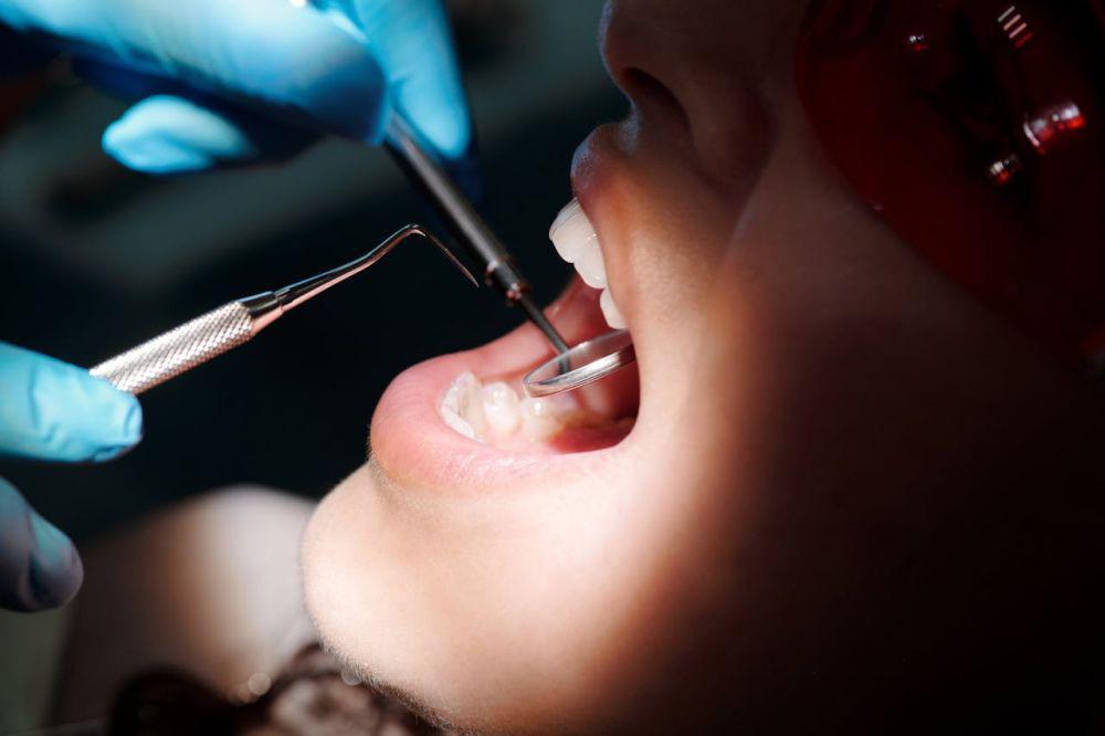 Manfaat Pasang Dental Sealant, Pelindung Gigi Berlubang