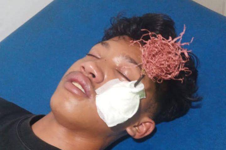 Pemuda di Makassar jadi korban penyerangan dengan panah. Anak panah tertancap di tulang pipi dekat mata kiri. (Dok. Istimewa)