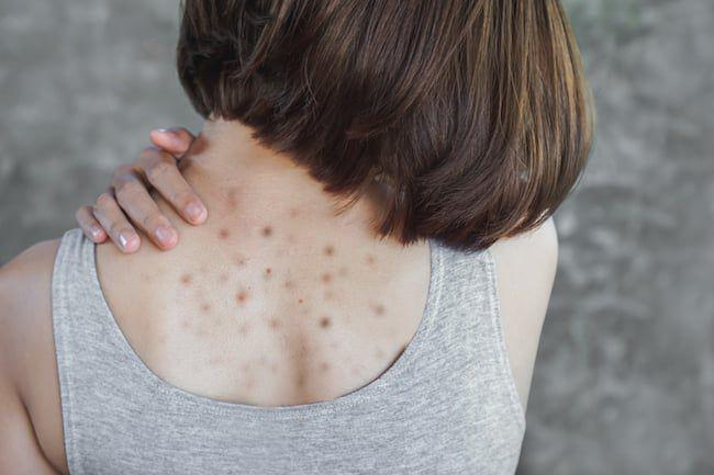 5 Kebiasaan Kecil yang Bisa Membuat Jerawat Tumbuh di Badan