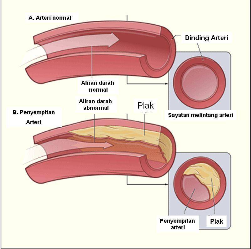 ilustrasi aterosklerosis (id.wikipedia.org/NHLBI)