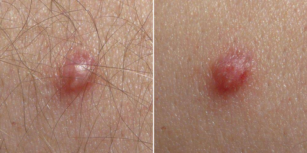 ilustrasi papilloma, infeksi HPV di kulit (commons.wikimedia.org/George Chernilevsky, derivative work Lämpel)