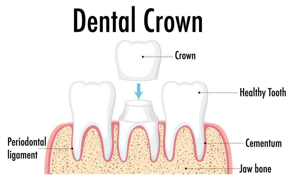 ilustrasi dental crown (freepik.com/brgfx)
