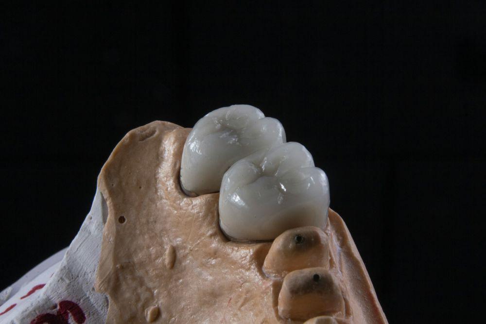 Dental Crown: Tujuan, Jenis, Prosedur