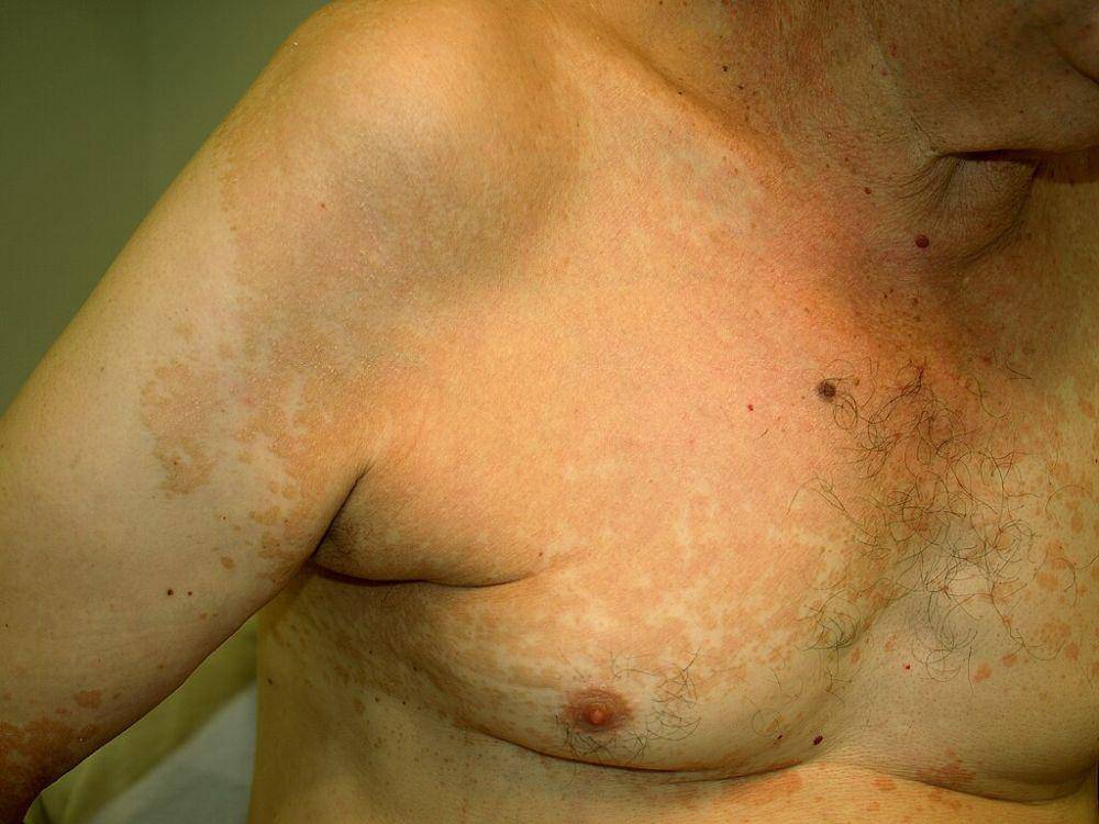 ilustrasi panu, pityriasis versicolor, atau tinea versicolor (commons.wikimedia.org/Klaus D. Peter, Wiehl, Germany)