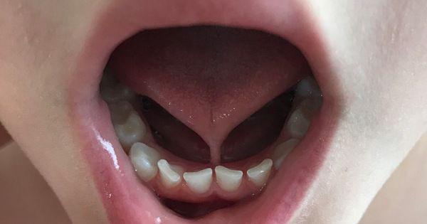 Apakah Lidah Semua Bayi dengan Tongue Tie Harus Dipotong?