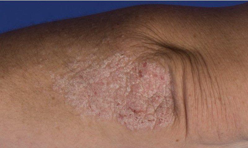 Ilustrasi gejala psoriasis pada siku (nhsinform.com)