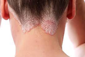 Punya Ketombe Bersisik? Bisa Saja Kamu Ada Psoriasis Kulit!