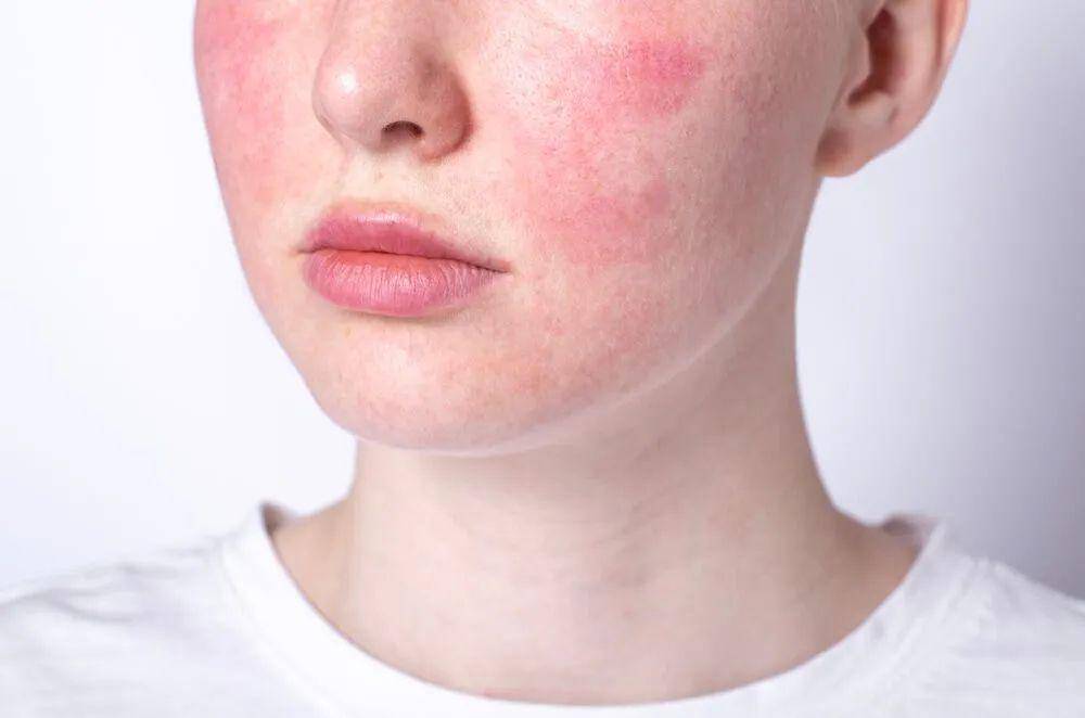 Ilustrasi kondisi kulit rosacea (spamedica.com)