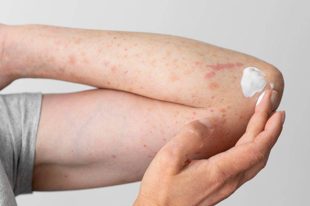 ilustrasi scabies (freepik.com/freepik)