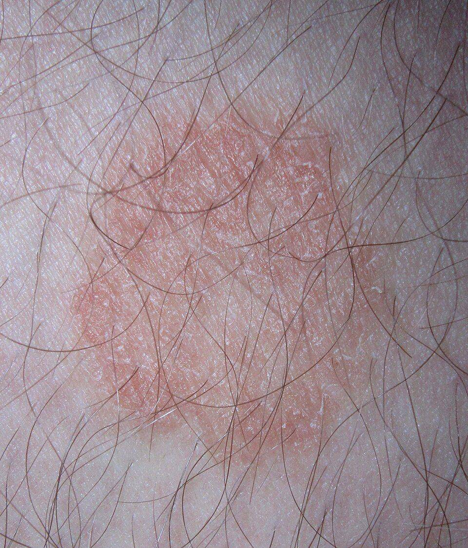 ilustrasi ringworm (commons.wikimedia.org/James Heilman, MD)