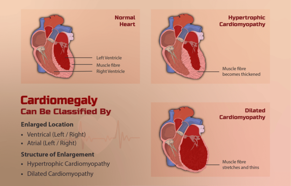 ilustrasi kardiomegaly atau pembengkakan jantung (commons.wikimedia.org/https://www.myupchar.com)