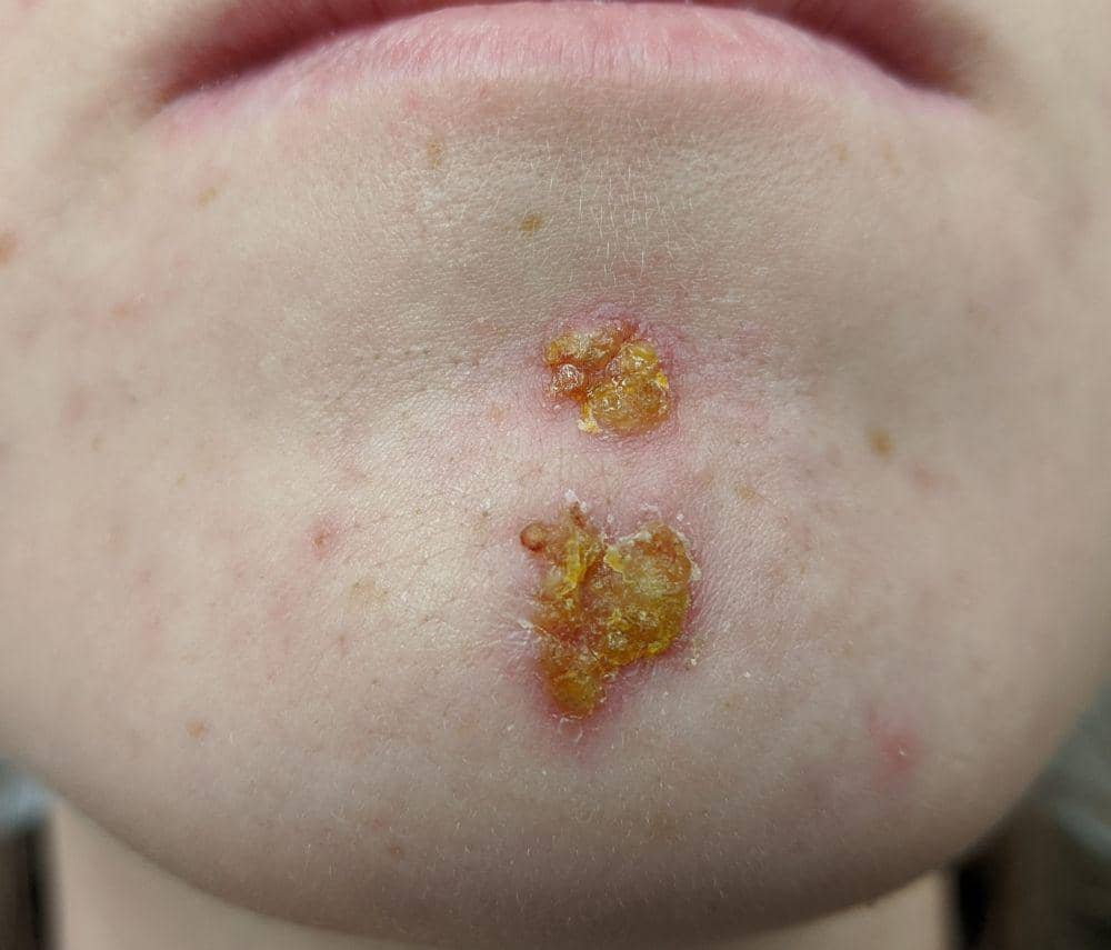 Ilustrasi penyakit impetigo (commons.wikimedia.org/James Heilman, MD)
