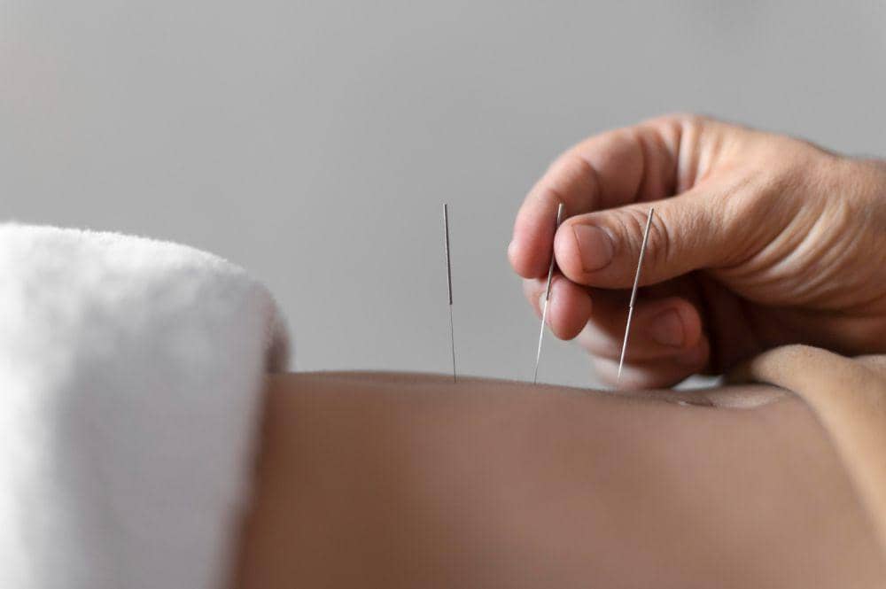 Apakah Akupunktur Bisa Menularkan HIV? Ini Kata Dokter
