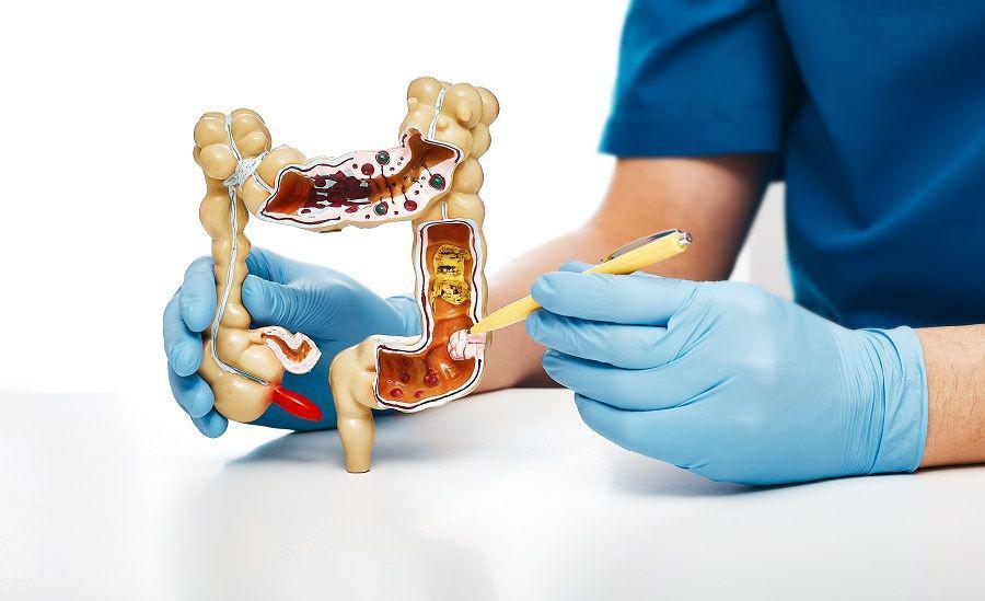 Deteksi Dini Kanker Usus Besar dengan Kolonoskopi
