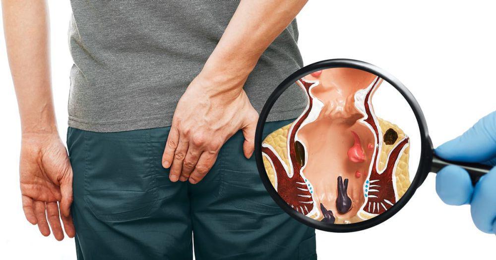 Catat, Ini 6 Daftar Makanan Penyebab Ambeien serta Pencegahannya