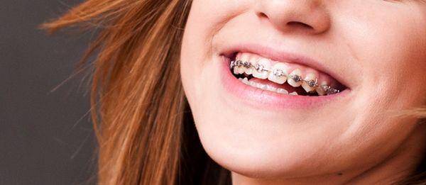 http://cdn.idntimes.com/content-images/post/20160229/brace-tawasbaydental-a20e9c3c5f4c8cb809ef79f3db20678a.jpg