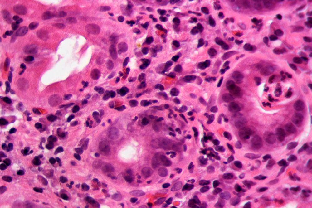 Helicobacter pylori (commons.wikimedia.org/Patho)