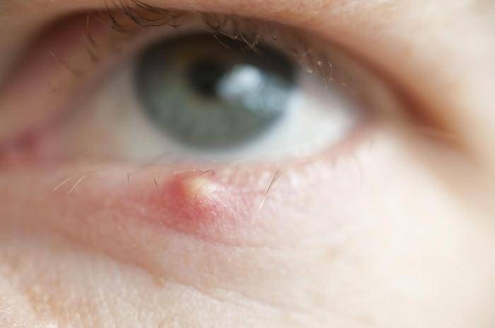 https://cdn.idntimes.com/content-images/post/20171128/eye-stye-314d5bd6c6f3e5f77d7908cb0a4c8b5c.jpg