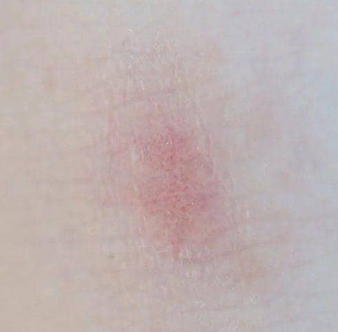 ilustrasi ruam merah pada kulit (pexels.com/Angela Roma)