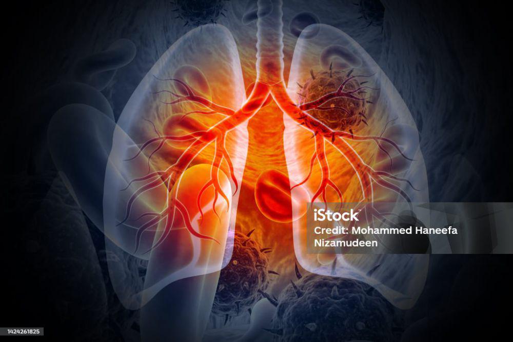 ilustrasi paru paru terkena penyakit tbc(istockphoto.com/Mohammed Haneefa Nizamudeen)