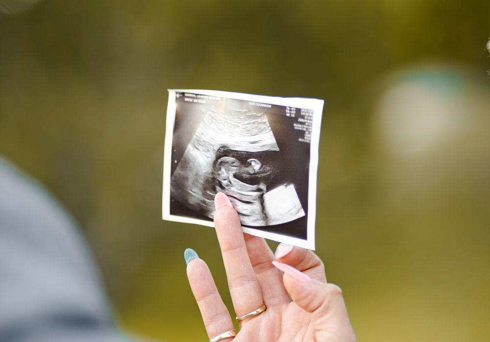 Apa Itu Vanishing Twin Syndrome?