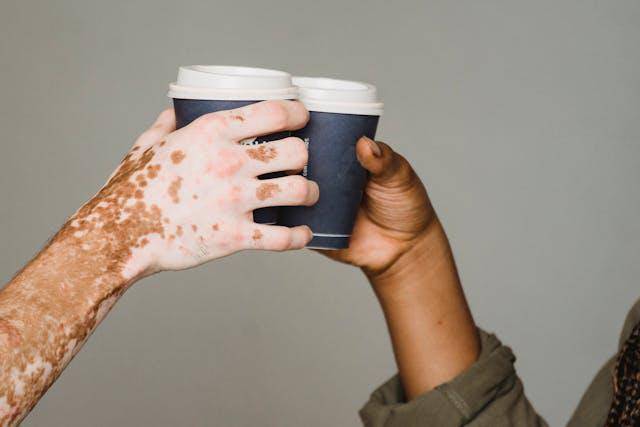 ilustrasi vitiligo (pexels.com/Armin Rimoldi)