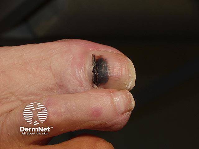 acral-lentiginous-melanoma-0008.jpg
