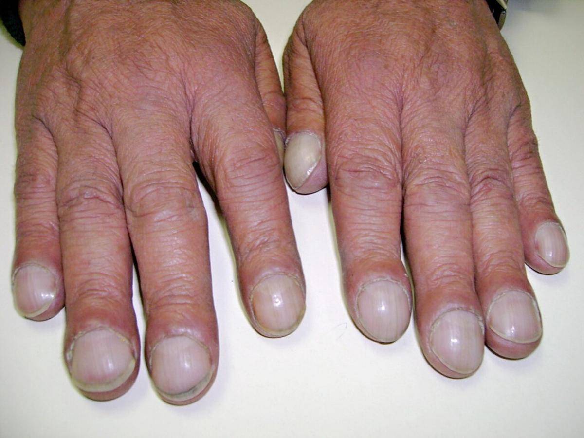 ilustrasi clubbing finger (wikipedia.org/Desherinka)