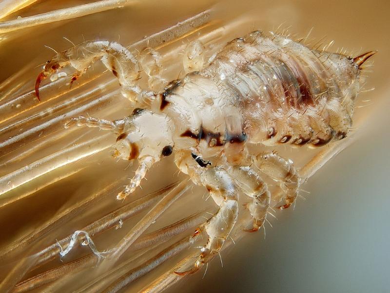 5 Cara Ampuh Hilangkan Telur Kutu Rambut dalam 1 Hari Secara Alami