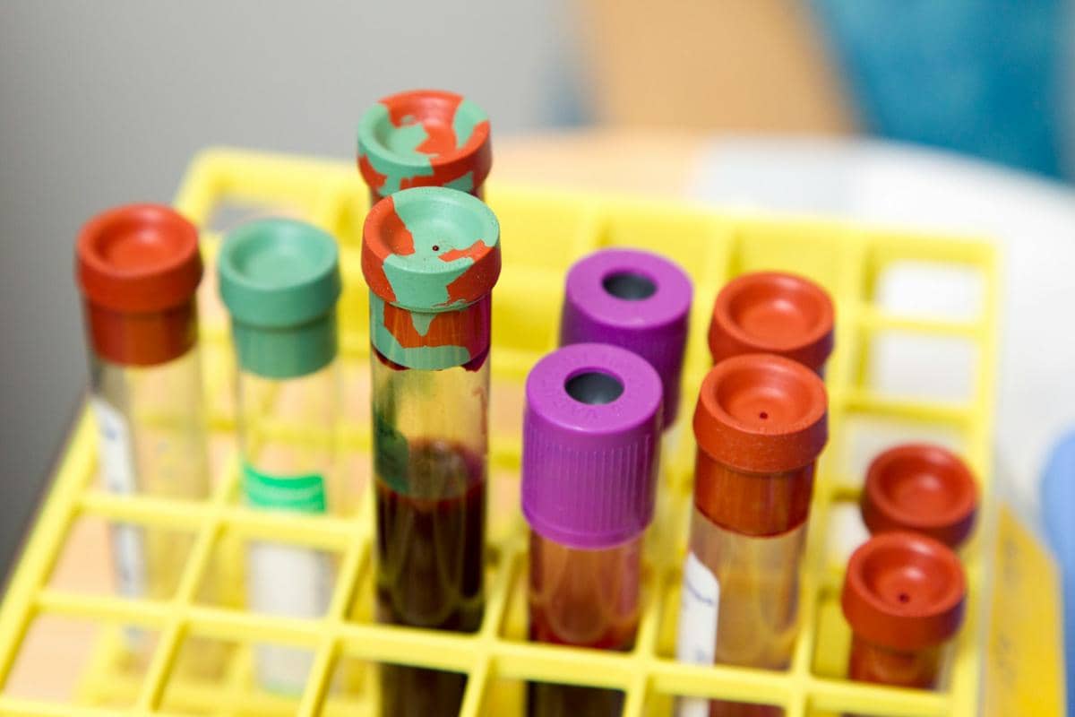 Tabung sampel darah dengan tutup berwarna berbeda tersusun di rak laboratorium untuk keperluan tes antibodi antinuklear (ANA).