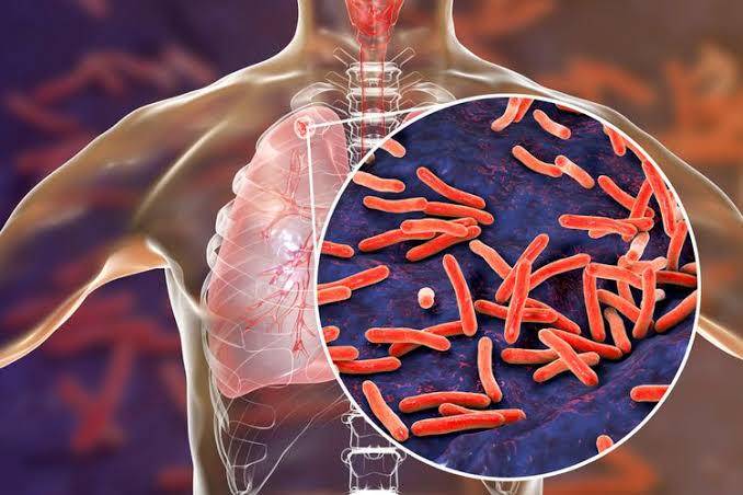 Ilustrasi foto TBC (Tuberkolosis) (Foto: Shutterstock)