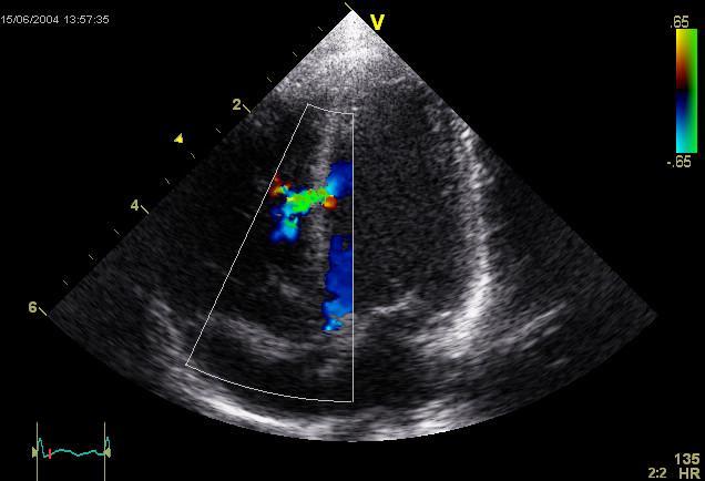 Gambar ultrasonografi jantung, ekokardiogram, yang menunjukkan defek septum ventrikel. (commons.wikimedia.org/Ekko)