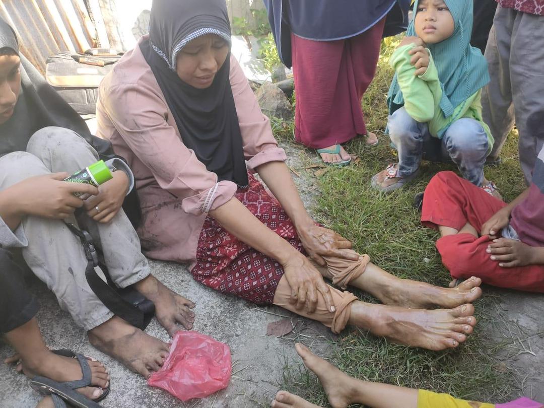 Tabung Gas Meledak, Perempuan di Padang Alami Luka Bakar