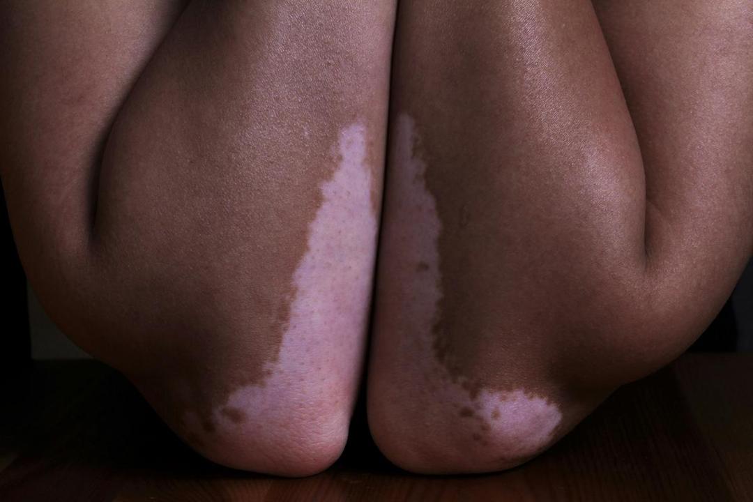 ilustrasi vitiligo (unsplash.com/Hanen Boubahri)