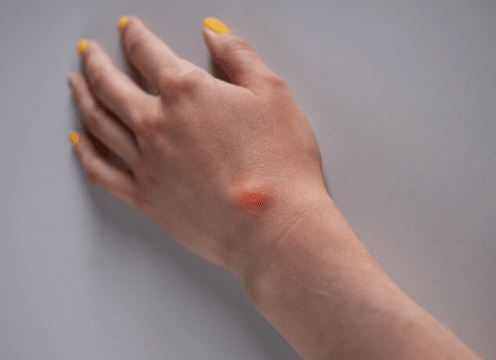 Ilustasi bisul di tangan.