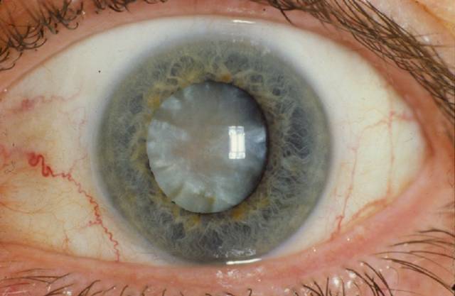 Katarak nuklear sklerosis. (commons.wikimedia.org/National Eye Institute)
